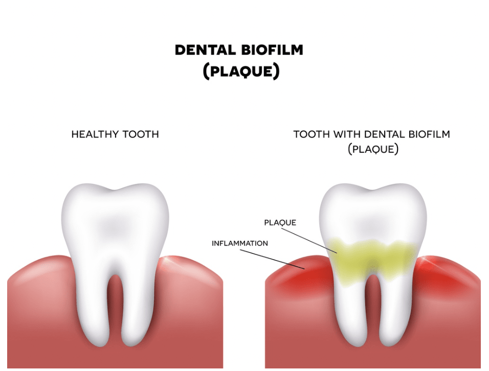Dental plaque, Cavities