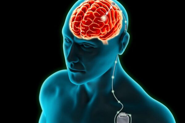 Revolutionizing Neurological Treatments: Best Hospitals in India for Deep Brain Stimulation (DBS) Revolutionizing Neurological Treatments
