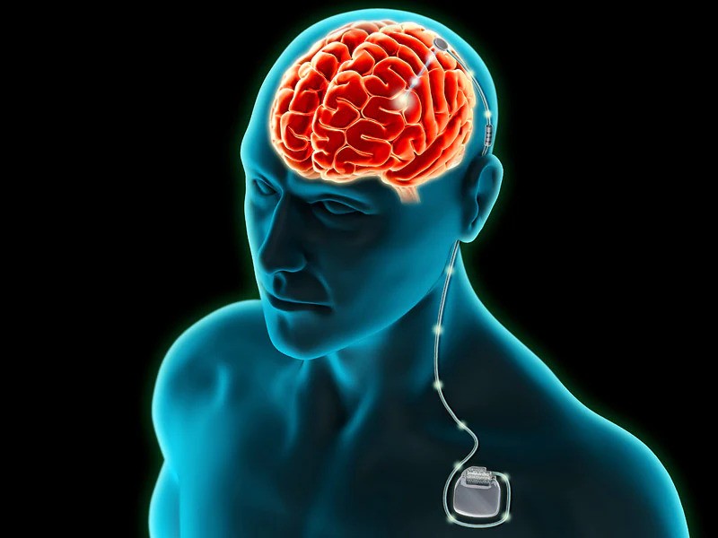 Revolutionizing Neurological Treatments: Best Hospitals in India for Deep Brain Stimulation (DBS) Revolutionizing Neurological Treatments